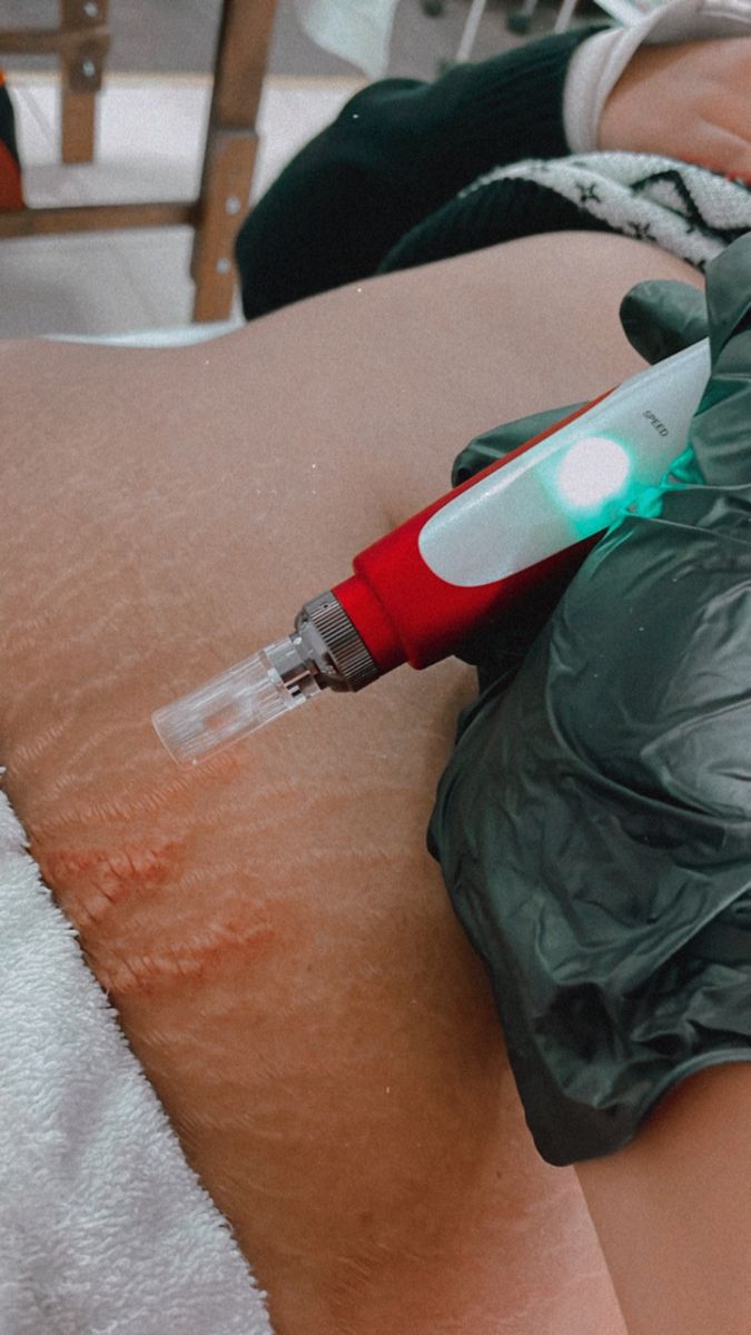 Crème, huile, laser, microneedling : que dit vraiment la science ?