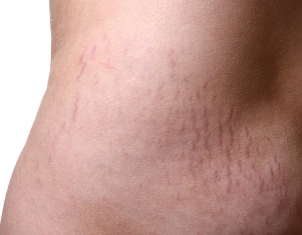 Vergetures rouges ou blanches : quelle différence et que faire ?