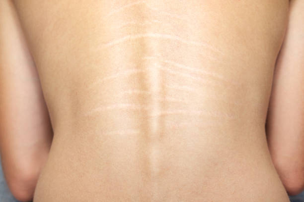 Vergetures et variations de poids : pourquoi elles apparaissent aussi quand on maigrit