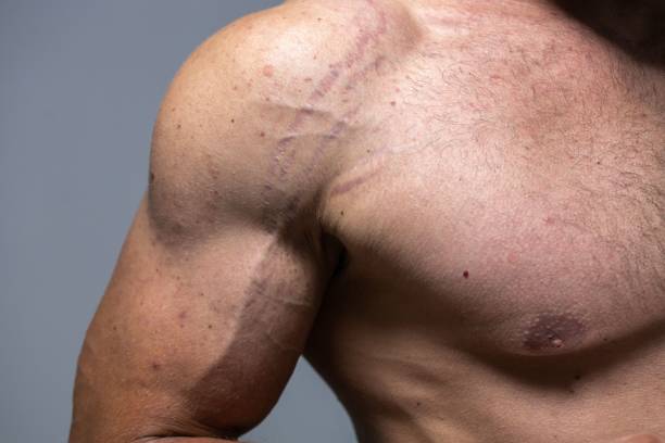 Vergetures et musculation : comment les prévenir pendant une prise de masse
